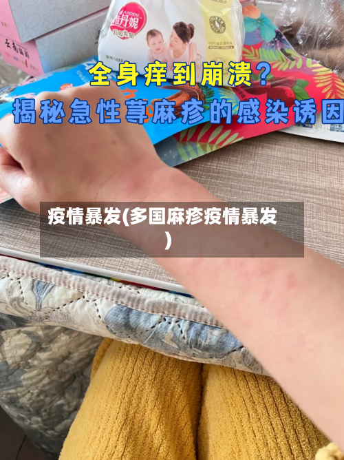 疫情暴发(多国麻疹疫情暴发)-第3张图片