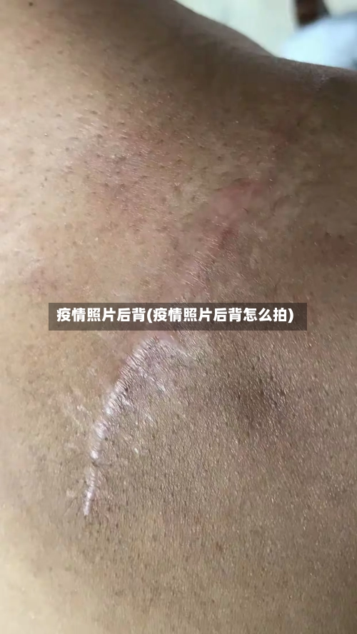 疫情照片后背(疫情照片后背怎么拍)-第2张图片