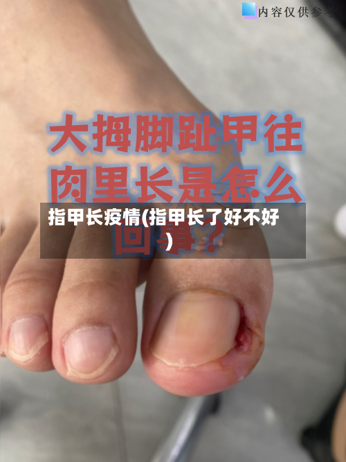 指甲长疫情(指甲长了好不好)-第2张图片