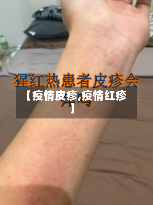 【疫情皮疹,疫情红疹】