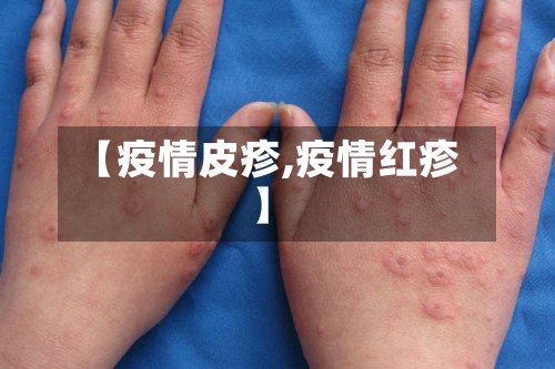 【疫情皮疹,疫情红疹】-第2张图片